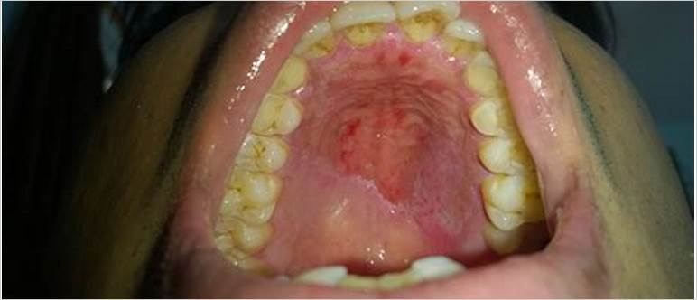 Peeling roof of mouth
